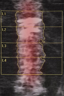 Ciddi osteoporoz ve coxarthrosis bağlantılı kırıkları olan yaşlı bir kadında omurilik yoğunluğunun teşhisi.