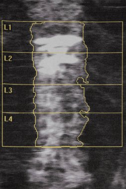 Ciddi osteoporoz ve coxarthrosis bağlantılı kırıkları olan yaşlı bir kadında omurilik yoğunluğunun teşhisi.