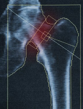Ciddi osteoporoz geçiren yaşlı bir kadının uyluk kemiğinde kemik yoğunluğu teşhisi, osteoporoz tespiti için tıbbi muayene.
