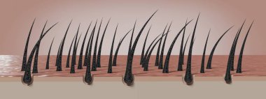 Kurumuş ve hasarlı saç kökleri - 3 boyutlu illüstrasyon