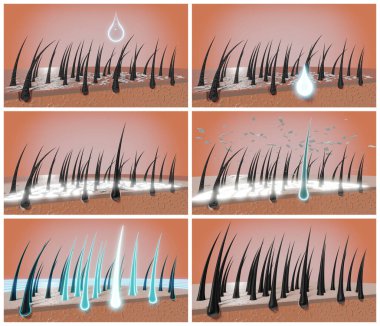 Saç kökleri ve kepek - terapide adımlar - 3 boyutlu illüstrasyon