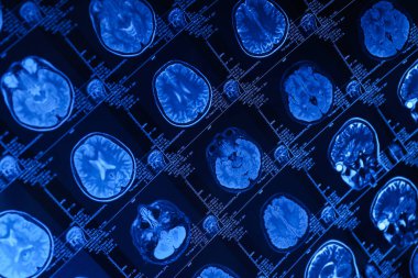 Beyin ve beyin MRI veya manyetik rezonans görüntüleme. Kapat.