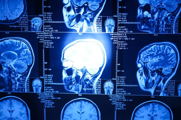 stock image MRI or magnetic resonance imaging of the head and brain. Close up