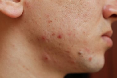 Genç adamın yüzündeki sivilceler, yaklaşın.