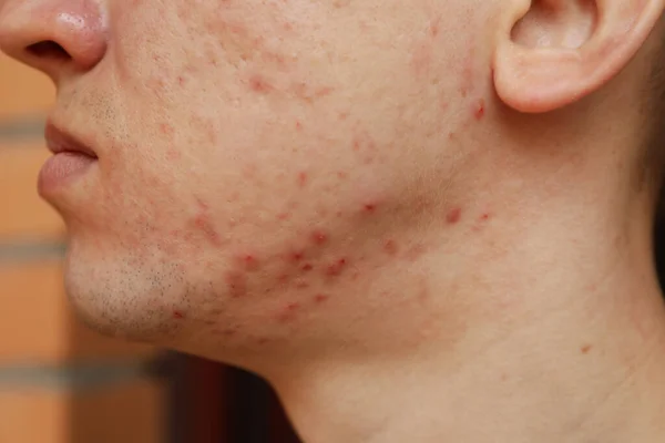 Pimples on face of young man, close up