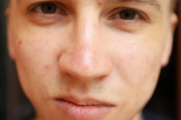 Skin condition of young man\'s face, close up