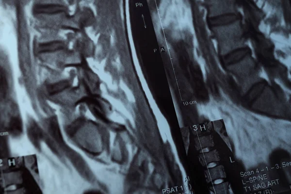 MRI or magnetic resonance imaging of the human spine