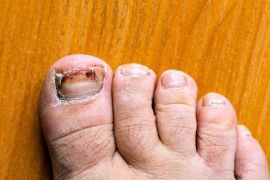 Kirli bir ayak tırnağıyla birinin ayağının yakın çekimi.