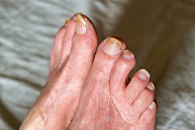 A close-up of a person's feet with toenails clipart