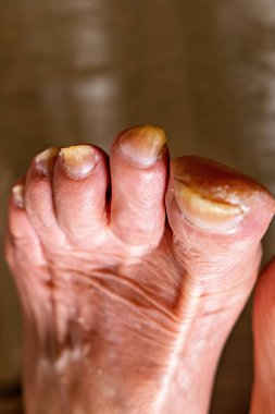 Kırık ve sarı tırnaklı bir insanın ayaklarının yakın çekimi.