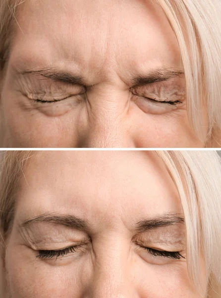 Fronte Una Vecchia Prima Dopo Procedura Botox Confronto Frontale Dopo — Foto Stock