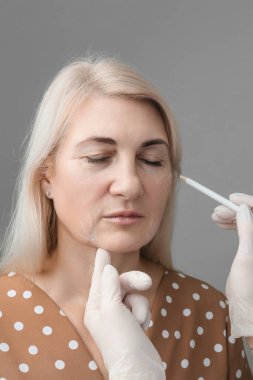 İplik yüz gerdirme, deri kaldırma konsepti. Mesothreads kullanılarak yüz hatları oluşturuluyor. Eldivenli bir güzellik uzmanı doldurma işlemleri için bir kadının yüzüne beyaz kalemle işaretler çizer.