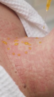 Deriyi temizlemek için bir ilaç kozmetoloji ofisinde boyuna damlatılır.