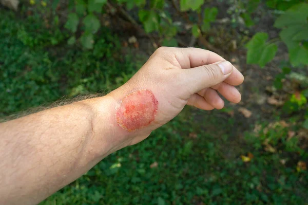 Eerstegraads Brandwond Aan Arm Van Een Man Grote Rode Wond — Stockfoto