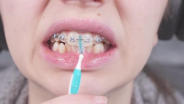 Teenager Βουρτσίζει Μεταλλικά Στηρίγματα Από Ορθοδοντικές Οδοντόβουρτσες Οδοντικό Νήμα Οδοντιατρική — Αρχείο Βίντεο