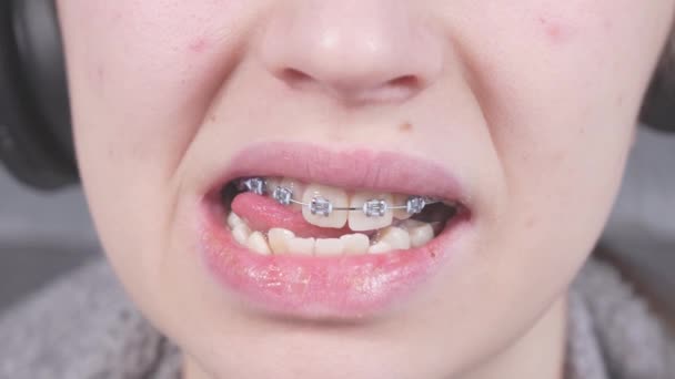 Girl Touching Her Metal Braces Tongue Close View Mouth Braces — Videoclip de stoc