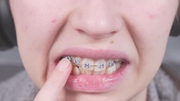 Girl Touching Her Metal Braces Finger Close View Mouth Braces — Stock Video