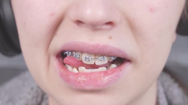 Dívka Jazykem Dotýká Kovových Rovnátek Blízký Pohled Ústa Rovnátky Ortodontická — Stock video