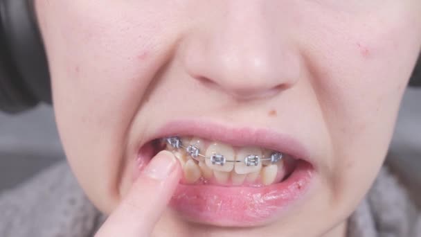 Dívka Prstem Dotýká Kovových Rovnátek Blízký Pohled Ústa Rovnátky Ortodontická — Stock video