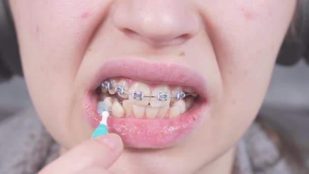 Teenager Βουρτσίζει Μεταλλικά Στηρίγματα Από Ορθοδοντικές Οδοντόβουρτσες Οδοντικό Νήμα Οδοντιατρική — Αρχείο Βίντεο