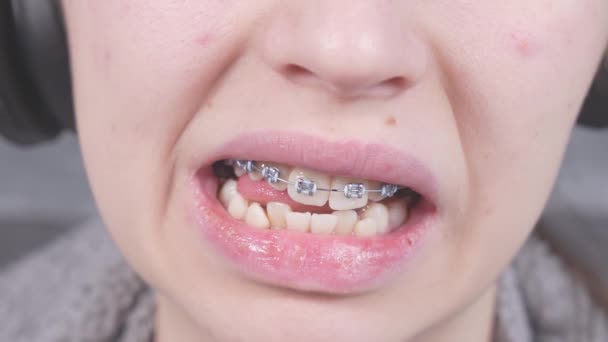 Dívka Jazykem Dotýká Kovových Rovnátek Blízký Pohled Ústa Rovnátky Ortodontická — Stock video