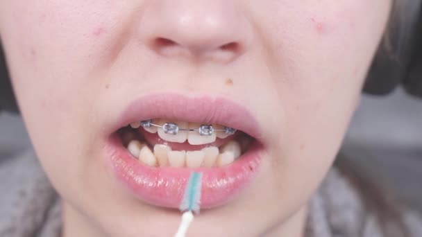 Cepillo Adolescente Soportes Metálicos Con Cepillos Dientes Ortodóncicos Hilo Dental — Vídeos de Stock