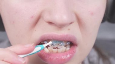 Teenager brushing metal brackets by orthodontic toothbrushes, dental floss. Dental care hygiene concept with braces. Cleaning braces teeth system, close-up. Oral care concept with braces