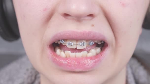 Girl Touching Her Metal Braces Tongue Close View Mouth Braces — Vídeos de Stock