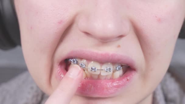 Девушка Пальцем Трогает Металлические Брекеты Закрыть Рот Морщинами Лечение Ортодонтии — стоковое видео