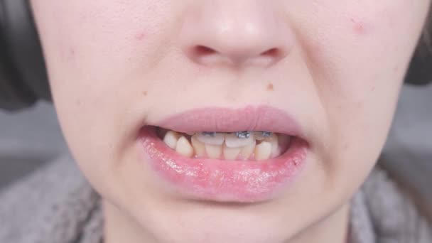 Girl Touching Her Metal Braces Tongue Close View Mouth Braces — Video Stock