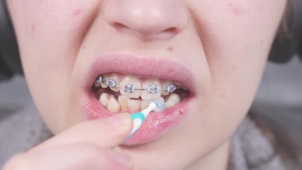 Teenager Čistí Kovové Držáky Ortodontickými Zubními Kartáčky Zubní Nití Koncept — Stock video