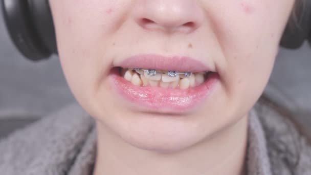 Girl Touching Her Metal Braces Tongue Close View Mouth Braces — Vídeos de Stock
