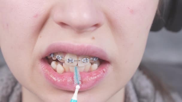 Teenager Čistí Kovové Držáky Ortodontickými Zubními Kartáčky Zubní Nití Koncept — Stock video