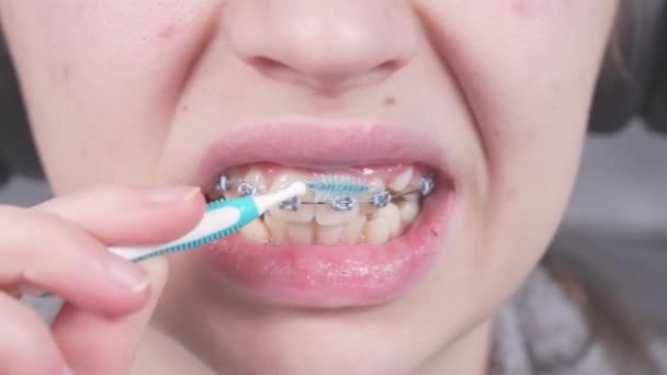 Teenager Brushing Metal Brackets Orthodontic Toothbrushes Dental Floss Dental Care — Vídeos de Stock