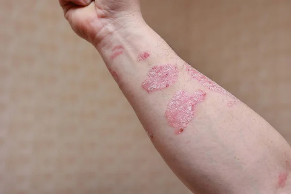 手部有病臂 手部皮肤干裂 寻常型银屑病 湿疹和其他皮肤病 如真菌 皮疹和伤痕 自身免疫性遗传病 — 图库照片