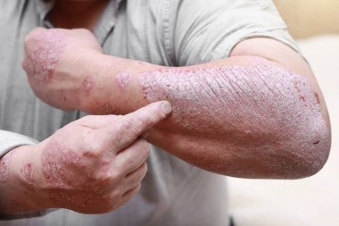 Acute form of psoriasis skin. Male showing arm with cracked, hard, horny, flaky skin. Dermatological problems of allergy, eczema. Hand stains, rash, dry skin. The concept of chronic disease treatment. clipart