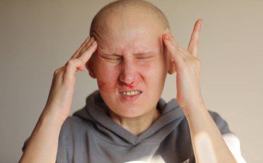 Kel kanser hastası kadın burnundan kanıyor, kemoterapinin etkisi. Kılsız, kanser hastası bir kadın. Baş ağrısı, elle dokunma ve burun kanaması. Yüzünde kırmızı kan var..