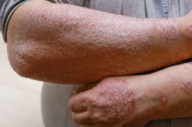 Kırmızı yaralı sedef hastalığı derisi. Kırık, sert, azgın, pullu derili erkek kolları. Dermatolojik alerji ve egzama sorunları. El lekeleri, kızarıklık, kuru cilt. Kronik hastalık tedavisi kavramı.