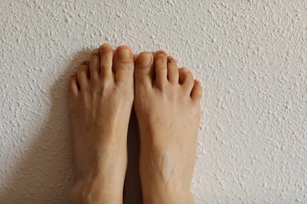 Female Feet Subungual Hematoma Black Toenails Caused Trauma Fungal Infection — Photo