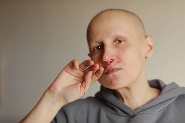 stock image Hairless cancer sick female patient is bleeding from her nose, effects of chemotherapy. Young bald woman lost her eyebrows and eyelashes and has heavy nosebleed with red blood on the face