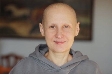 Gülümseyen tüysüz genç bayan hasta onkolojiyle boğuşuyor. Evdeki kameraya bak. Kemoterapiden sonra kel kanseri olan kadın kaşlarını ve kirpiklerini kaybetmiş. İyileşme konusunda iyimser..
