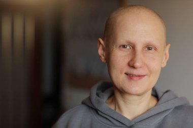 Gülümseyen tüysüz genç bayan hasta onkolojiyle boğuşuyor. Evdeki kameraya bak. Kemoterapiden sonra kel kanseri olan kadın kaşlarını ve kirpiklerini kaybetmiş. İyileşme konusunda iyimser..