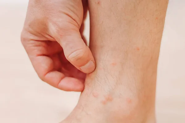 近距离男子抓挠与手过敏皮疹的腿 由昆虫叮咬引起的红疹 毛囊炎 真菌感染受影响的红斑及皮肤肿大 — 图库照片