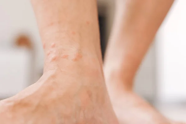 关闭过敏性皮疹湿疹在人的脚 由昆虫叮咬引起的红疹 毛囊炎 真菌感染受影响的皮肤区域会发红 发斑及肿胀 — 图库照片