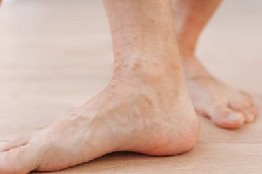 Yaya olarak alerjik deri iltihabı egzamasını kapat. Böcek ısırığından kaynaklanan kızarıklıklarla dolu bir bacak. Dermatit, folikülit, mantar enfeksiyonu. Etkilenmiş derinin kızarması, kızarması ve şişmesi.