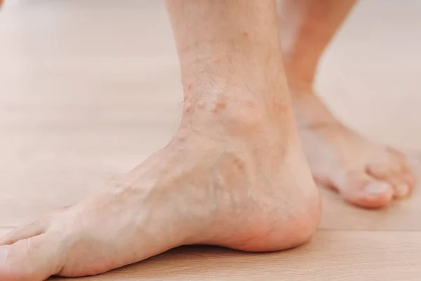 Zamknąć Alergiczny Wysypka Zapalenie Skóry Wyprysk Stopie Człowieka Noga Czerwoną — Zdjęcie stockowe