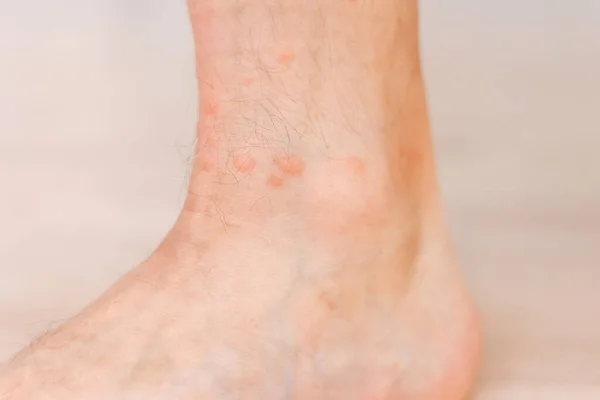 关闭过敏性皮疹湿疹在人的脚 由昆虫叮咬引起的红疹 毛囊炎 真菌感染受影响的皮肤区域会发红 发斑及肿胀 — 图库照片