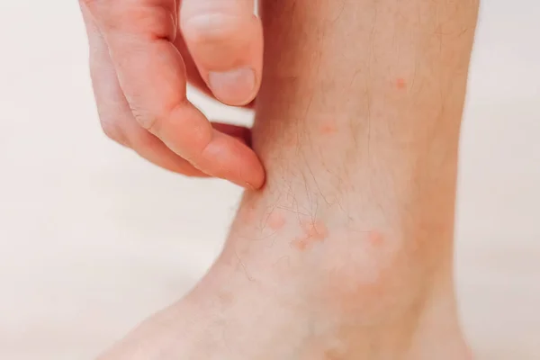 足に手のアレルギー性発疹で引っ掻く男を閉じます 虫刺されによって引き起こされる赤い発疹の足 皮膚炎 濾胞性炎 真菌感染症 赤と白の影響を受ける領域と肌を腫らすために — ストック写真