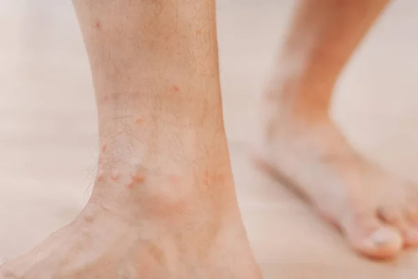 Закрыть Аллергическую Сыпь Дерматита Экзема Ноге Человека Нога Красной Сыпью — стоковое фото