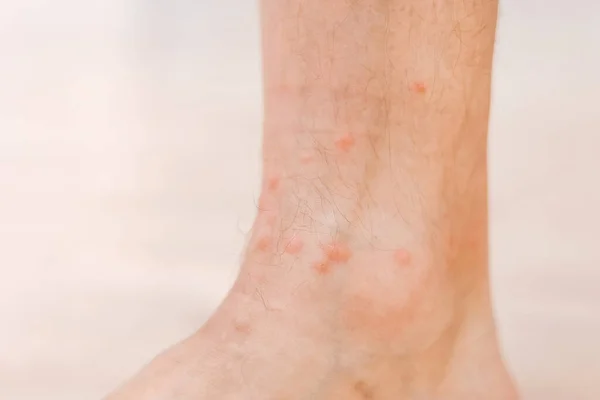 Закрыть Аллергическую Сыпь Дерматита Экзема Ноге Человека Нога Красной Сыпью — стоковое фото